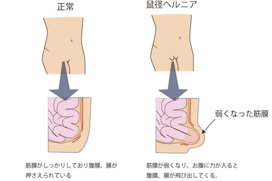 鼠蹊 部 腫れ