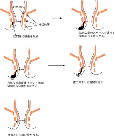 痔ろうのでき方