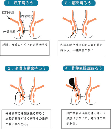 痔ろうの種類