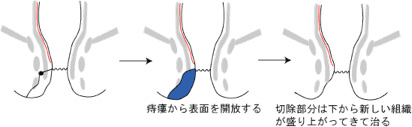 解放術