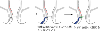 くりぬき法