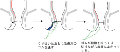 シートン法