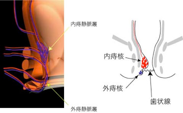 内痔核