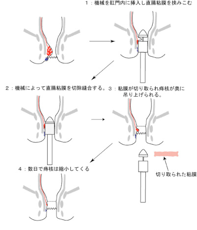 Procedure for Prolapse and Hemorrhoids(PPH)