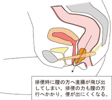 直腸瘤2