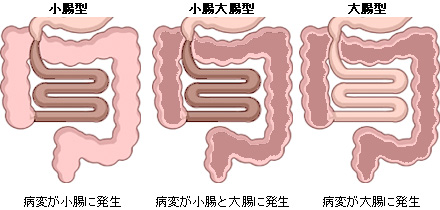 クローン病の病型