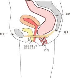 膀胱瘤または膀胱脱