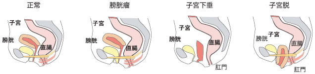 膀胱瘤または膀胱脱